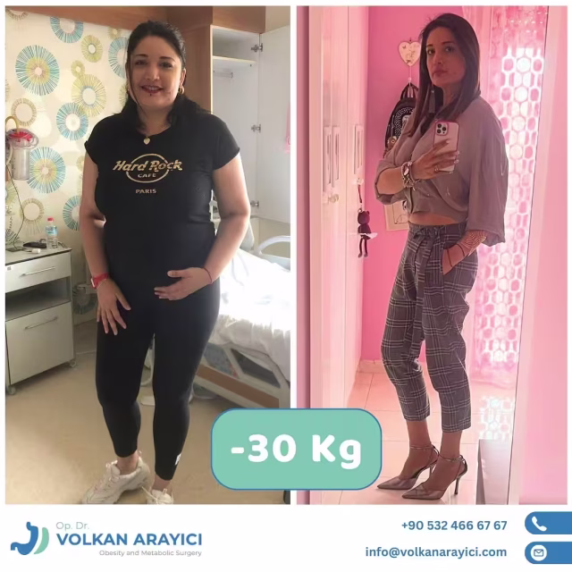 Balón gástrico Turquía antes y después: paciente con 30 kg menos