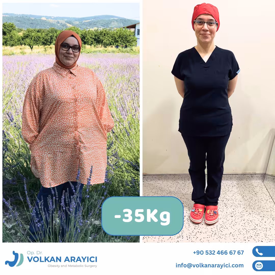 Balón gástrico antes y después: paciente con 35 kg menos