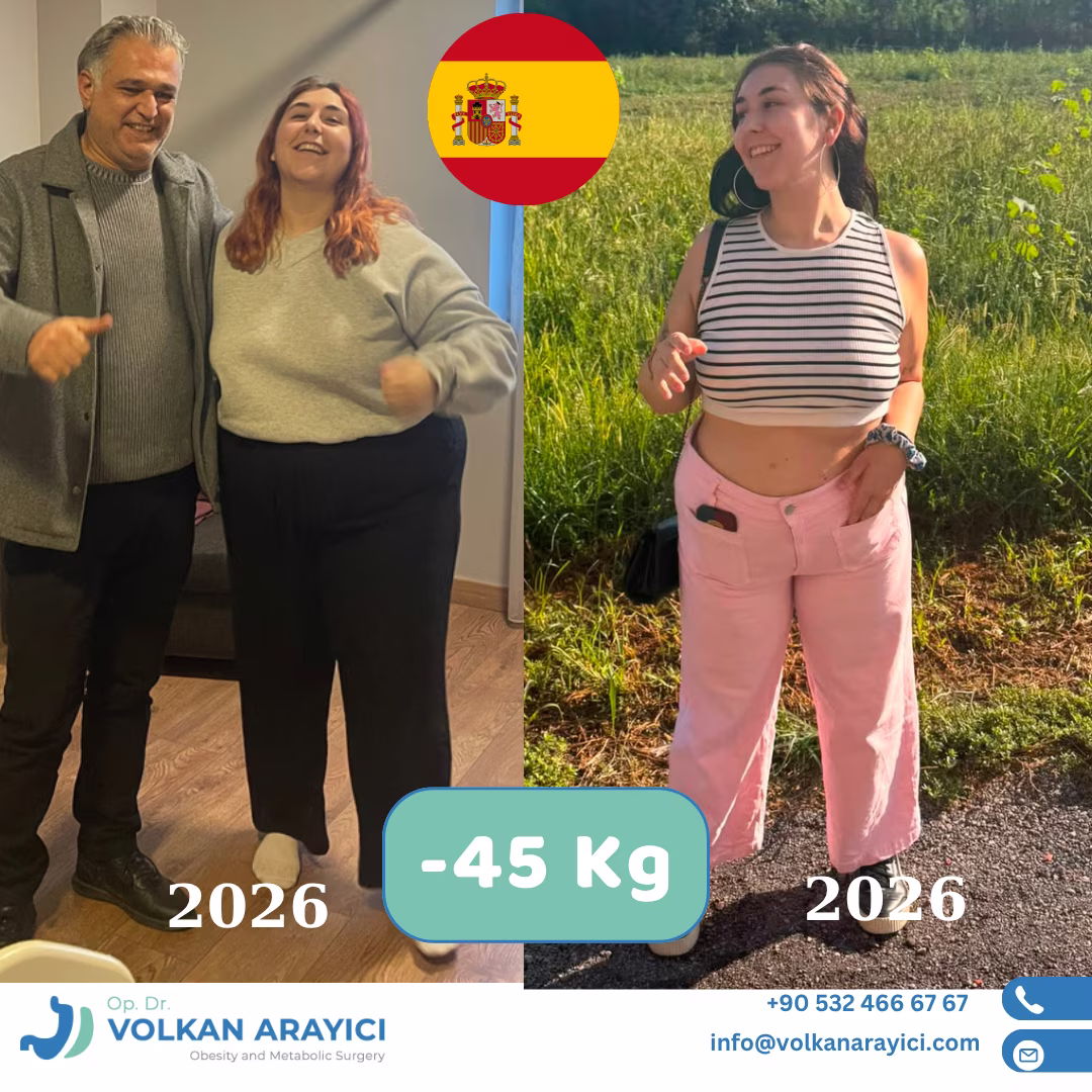 Conversión de banda gástrica a manga en Turquía antes y después: 45 kg menos