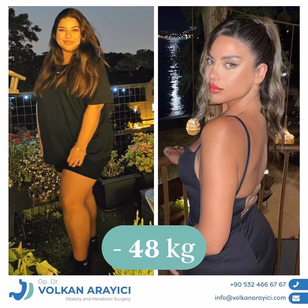 Bypass gástrico antes y después: paciente con 48 kg menos
