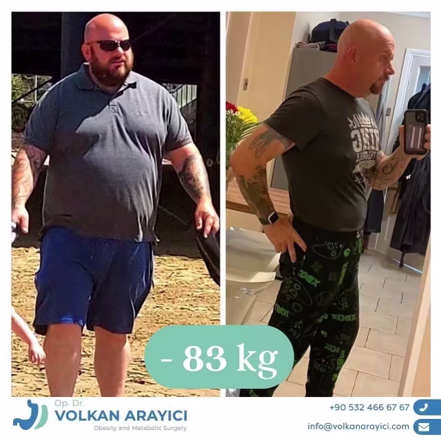 Bypass gástrico antes y después: hombre con 83 kg menos