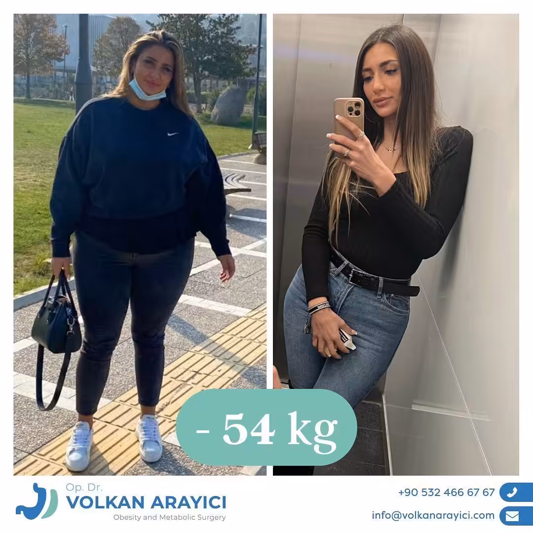 Cirugía de revisión bariátrica en Turquía antes y después: paciente con 54 kg menos