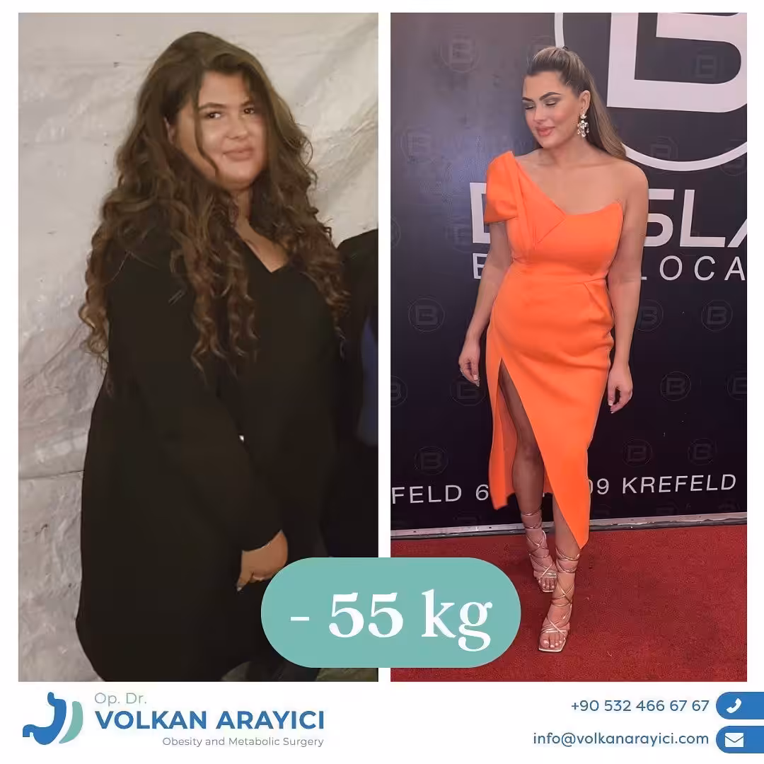 Cirugía de revisión bariátrica en Turquía antes y después: paciente con 55 kg menos