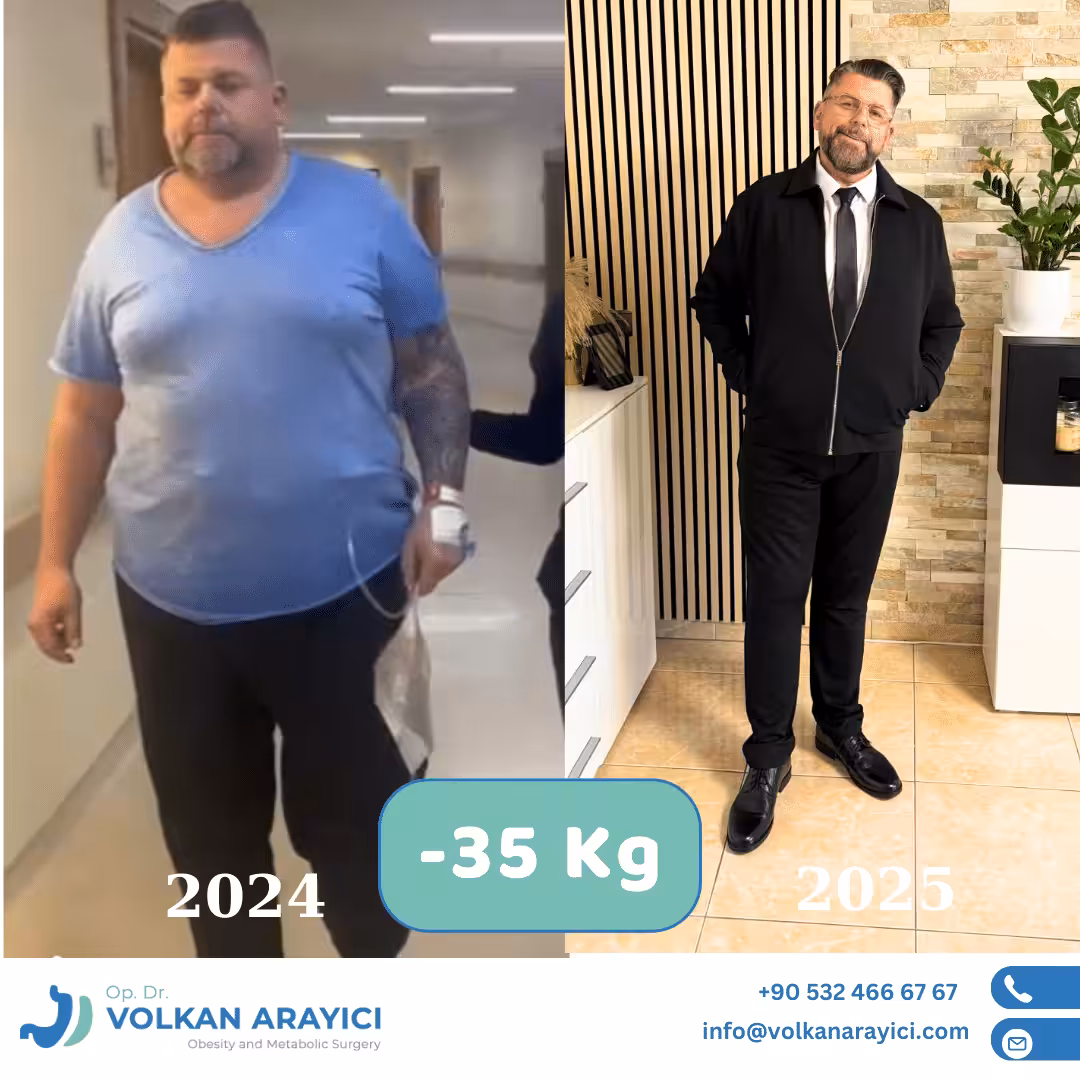 Manga gástrica antes y después: hombre con 35 kg menos en un año