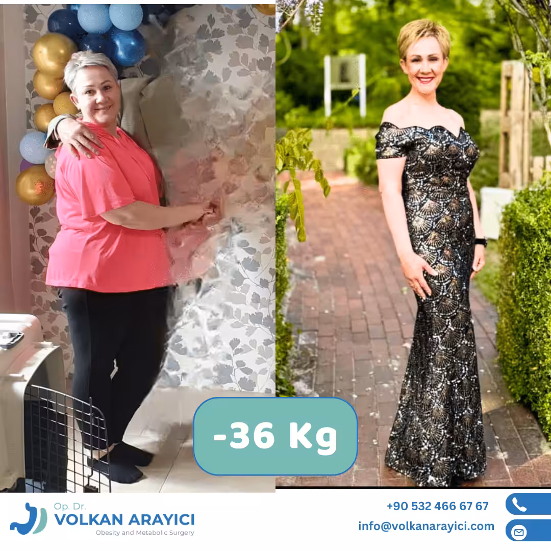 Manga gástrica antes y después: paciente con 36 kg menos