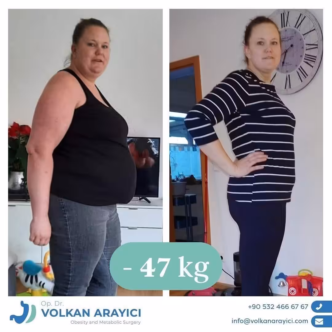 Manga gástrica Turquía antes y después desde el mismo ángulo: 47 kg menos
