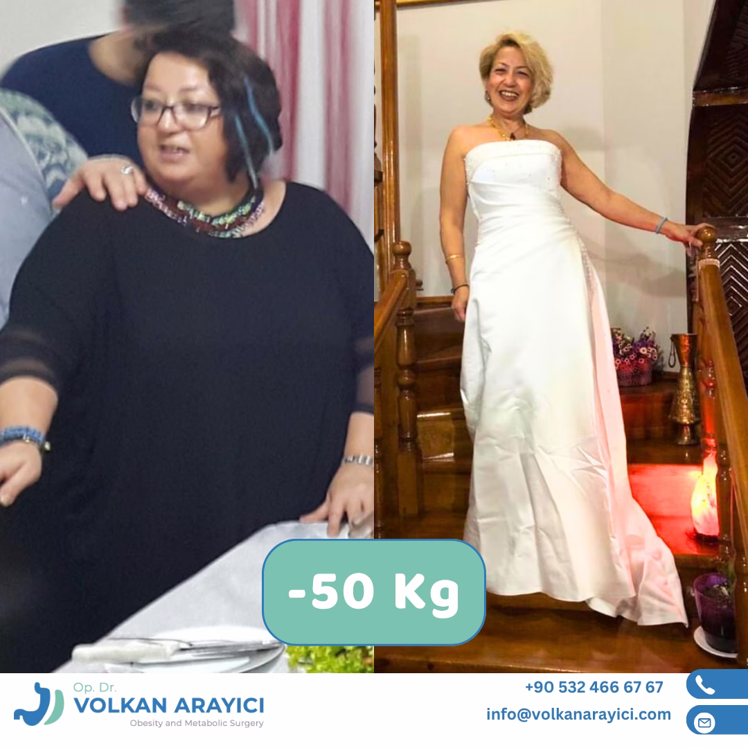 Manga gástrica antes y después: paciente con 50 kg menos