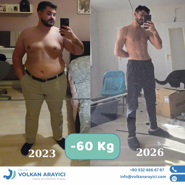 Manga gástrica antes y después: paciente con 60 kg menos a los dos años y medio