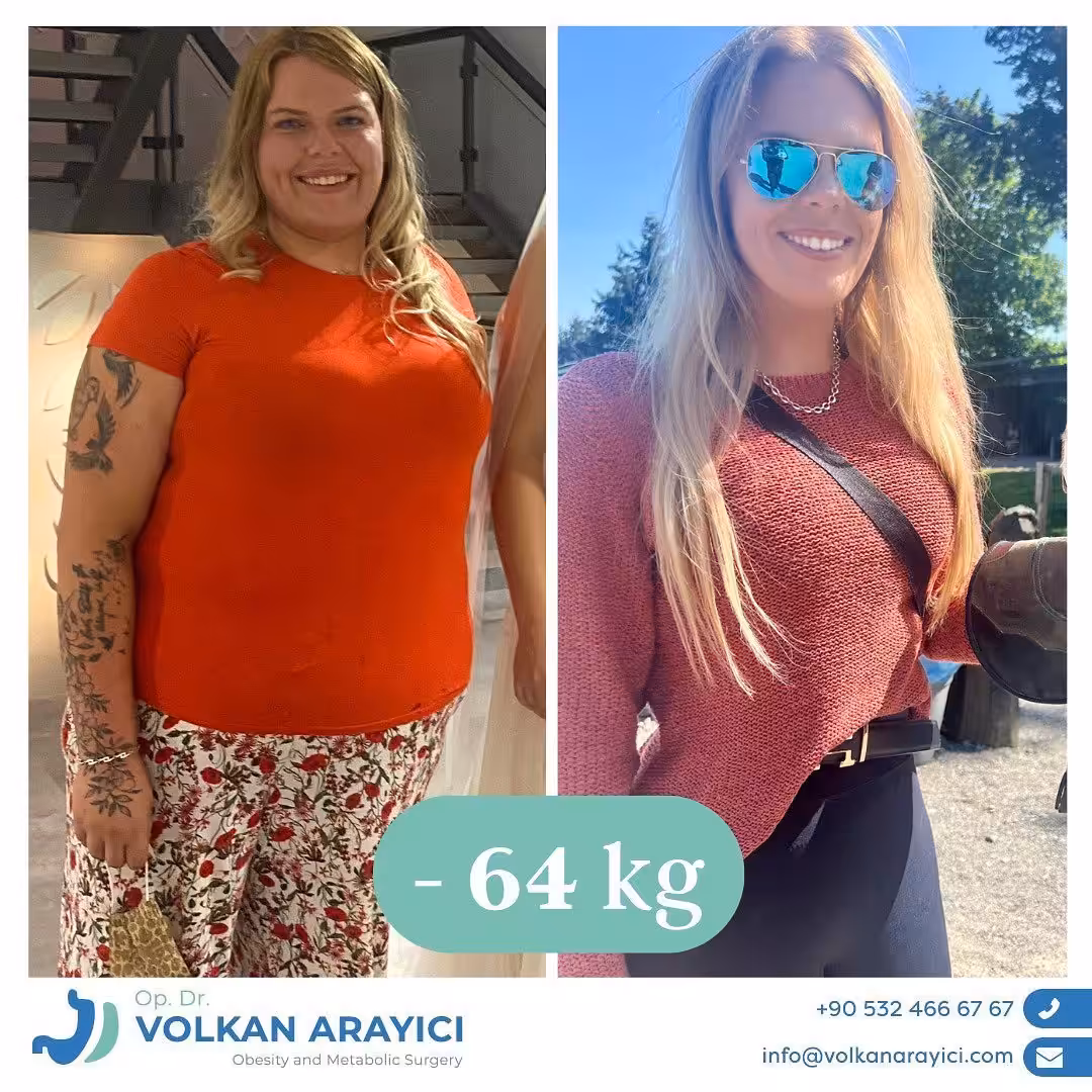 Manga gástrica antes y después: paciente con 64 kg menos