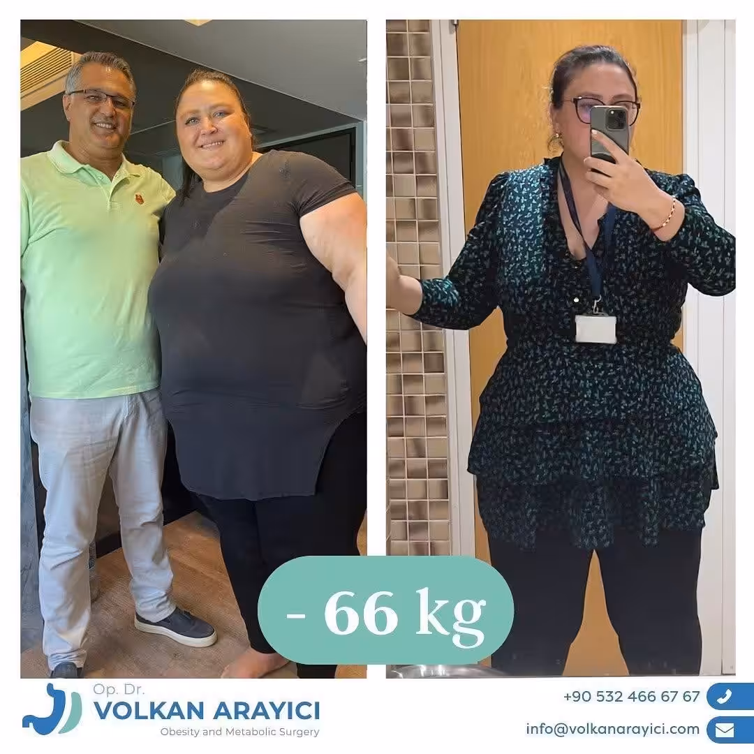 Manga gástrica antes y después: paciente con 66 kg menos