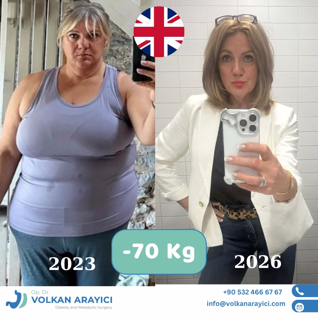 Manga gástrica antes y después: paciente con 70 kg menos
