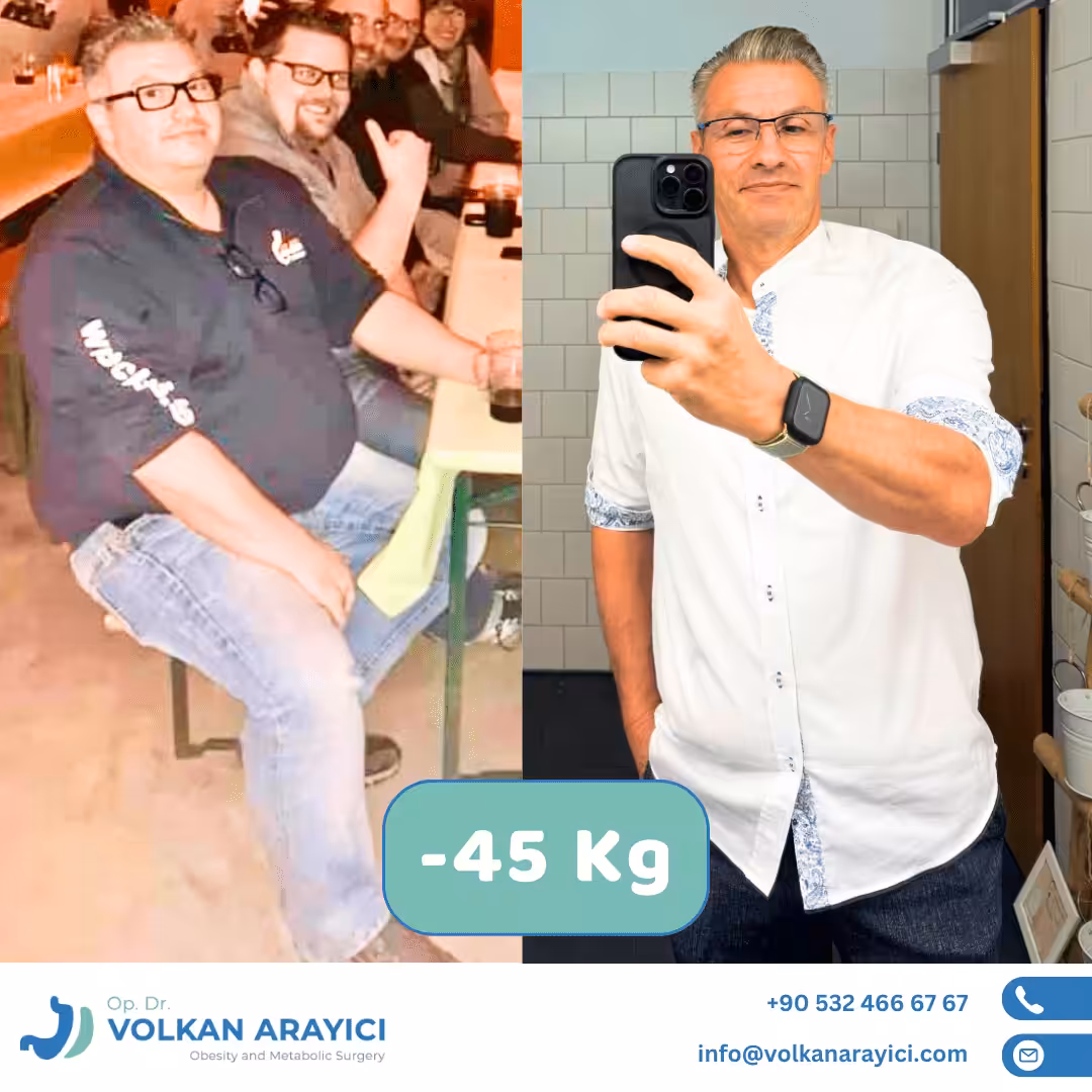Manga gástrica antes y después: hombre con 45 kg menos