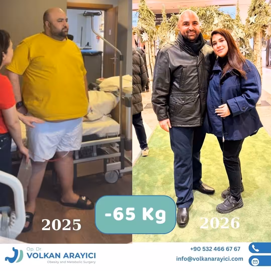 Manga gástrica antes y después: hombre con 65 kg menos