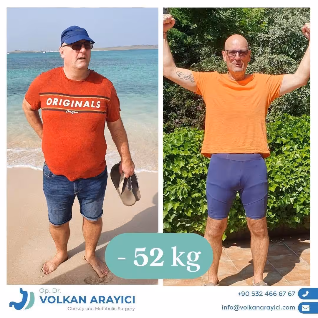 Remanga gástrica en Turquía antes y después: hombre con 52 kg menos